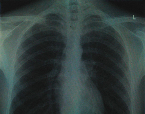 chest x-ray